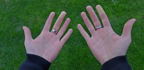 Raynaud-Syndrom-Weißfinger-Hände-frieren