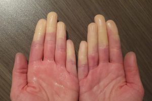 Hände mit Raynaud-Syndrom: weiße Finger