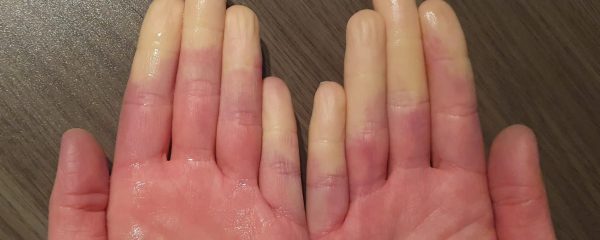 Hände mit Raynaud-Syndrom: weiße Finger