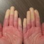 Hände mit Raynaud-Syndrom: weiße Finger