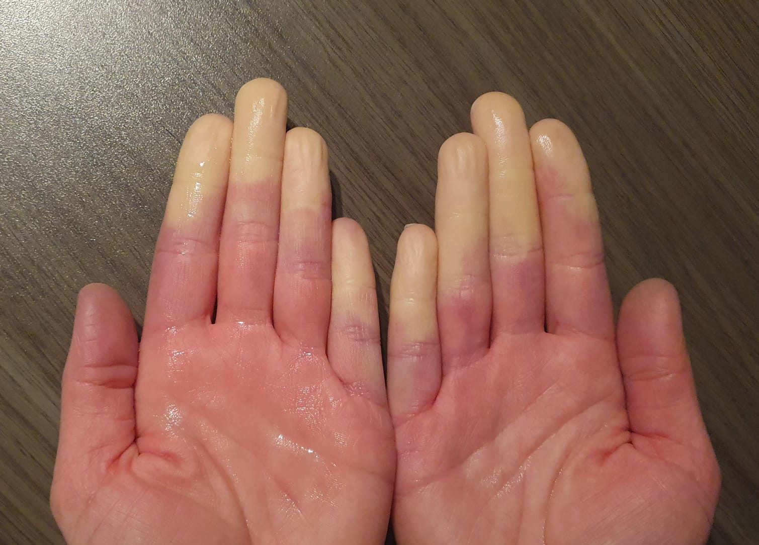 Hände mit Raynaud-Syndrom: weiße Finger